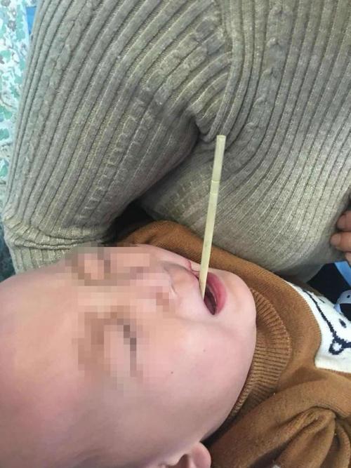 新门内部资料内部网站和大爷误吞20cm筷子与误吞筷子怎么办
